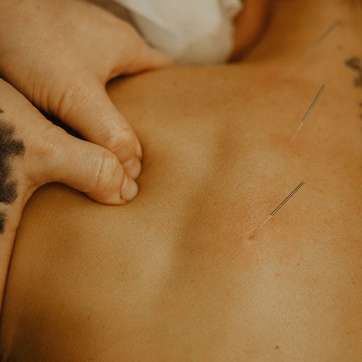 Fine acupuncture needles placed across a client's upper back